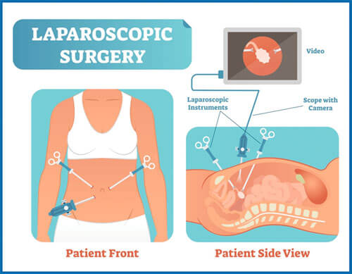 laparoscopic-surgery-pic